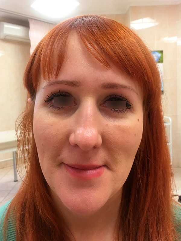 Трансконъюнктивальная билатеральная блефаропластика: фото после