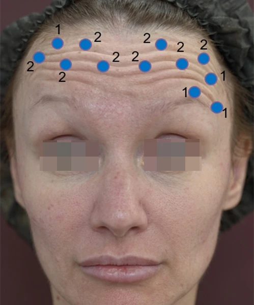 Коррекция препаратом Belotero