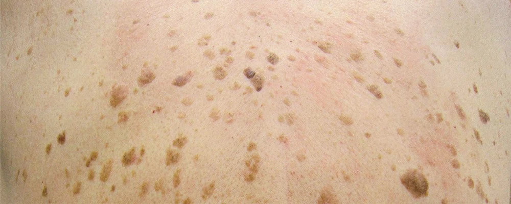 Кератоз, Себорейный кератоз