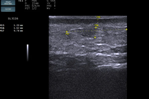 Сонограмма дермального имплантата
