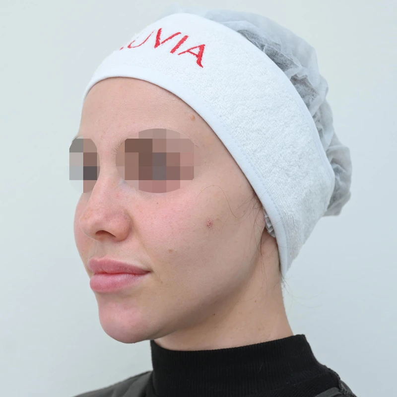 Процедура Fresh&Lift, фото до