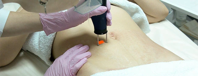 Коррекции стрий лазером