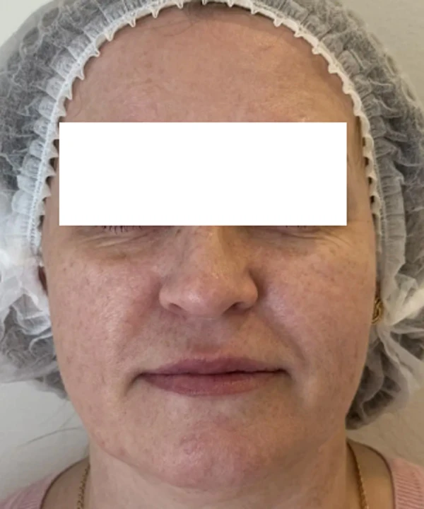 Alma Hybrid, фото до