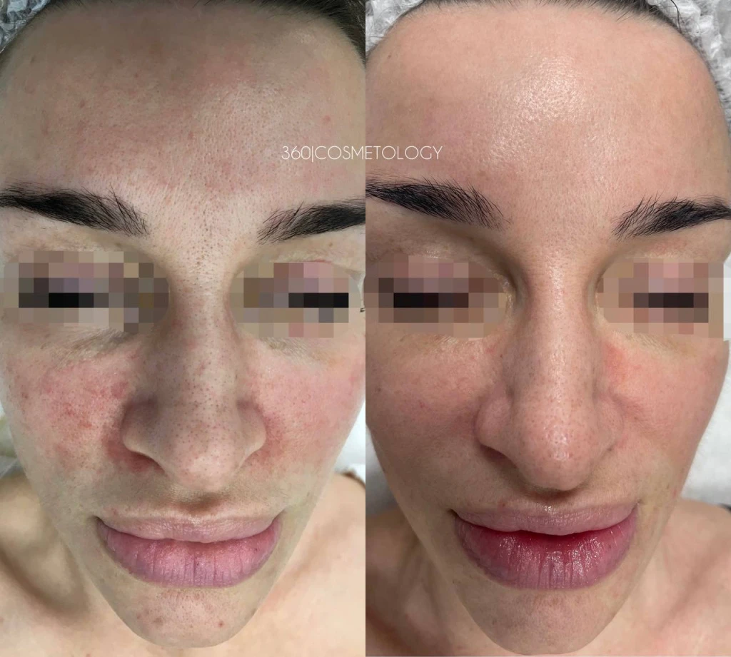 терапия HELEO4™