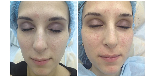 Фото до и после плазмолифтинга