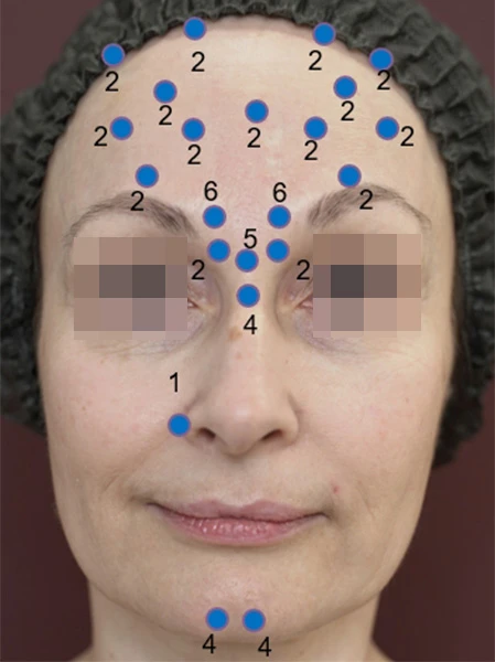 Разметка для введения препарата Ксеомин