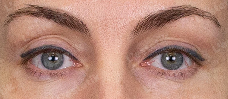 RF-лифтинг Ashley, фото После