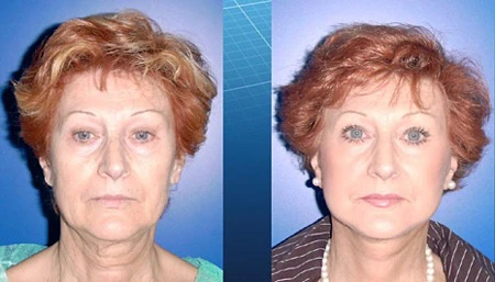 лигатурный лифтинг до и после, лигатурный лифтинг