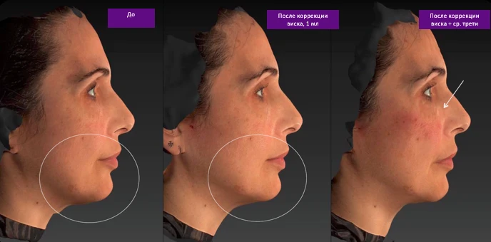 Техника В.UP филлерами Belotero, фото до и после