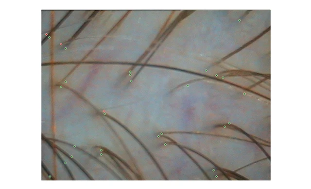 Затылочная зона при диффузном выпадении волос