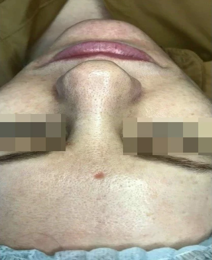 Acless spot peel