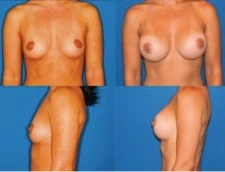 Пример груди 1 класса