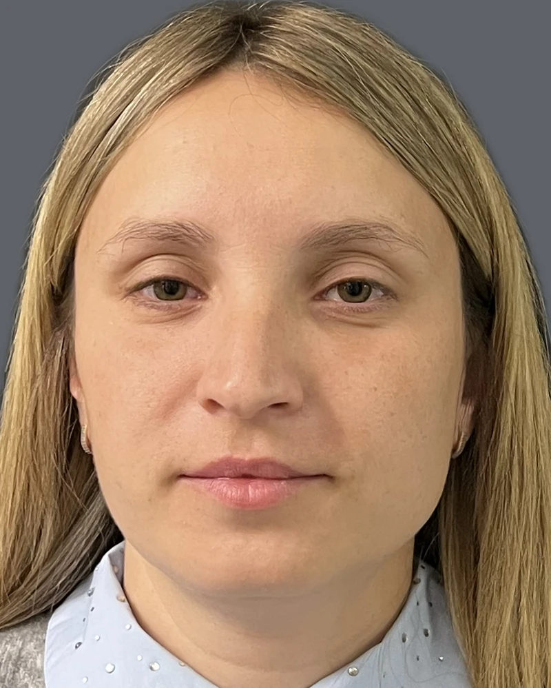 RF-лифтинг