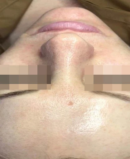 Acless spot peel