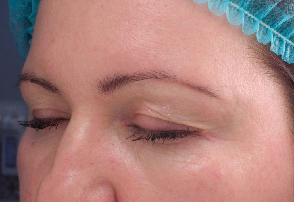 Применение Ultherapy