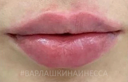 Коррекция губ филлером Etermis 4, фото После