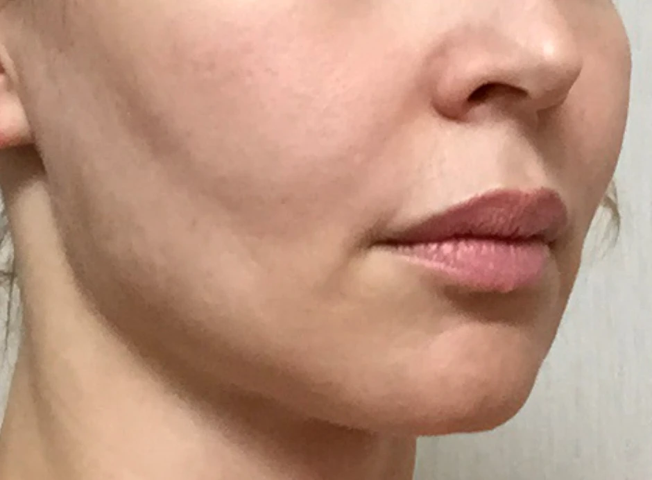 Ксеомин, Жевательная мышца