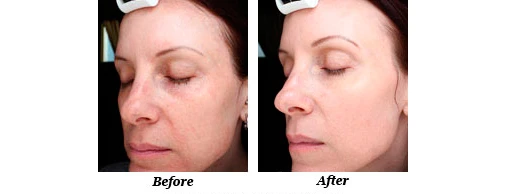 SkinPen