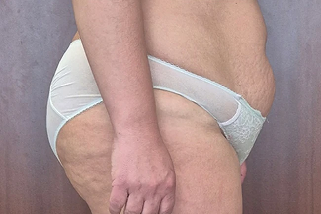 После, криолиполиз CoolShaping 2