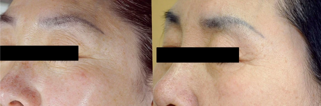 До и после Scarlet RF