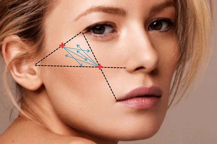 скуловая область, разметка, Restylane Perlane