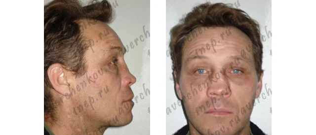 Пациент в фас и в профиль до операции