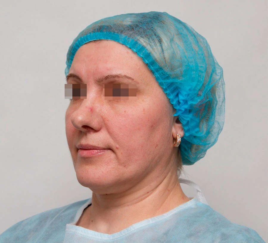 Применение Ultherapy