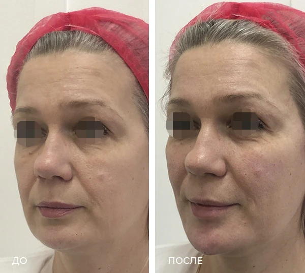 заднетемпоральный лифтинг