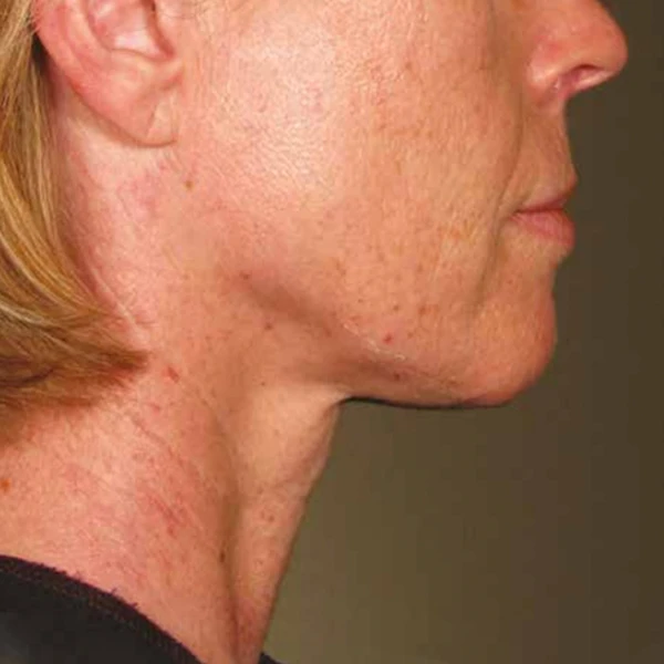 Ulthera System фото до и после