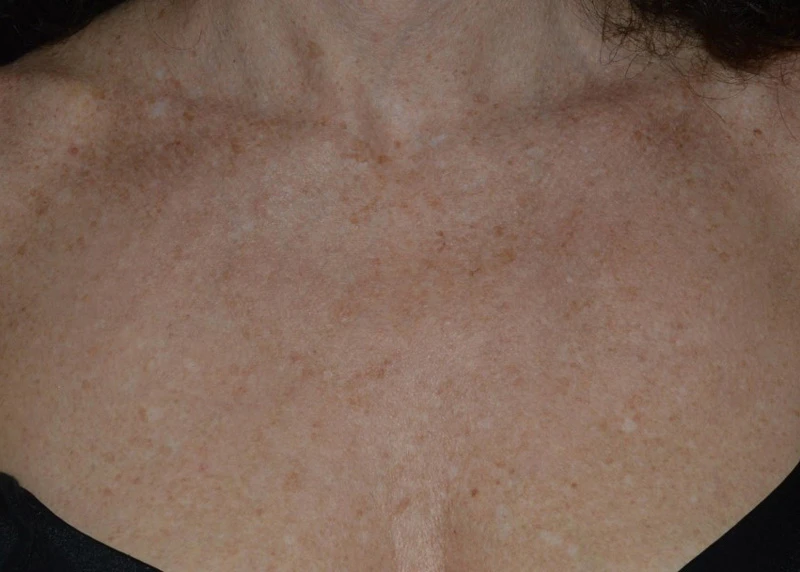 LaseMD Ultra // До процедуры