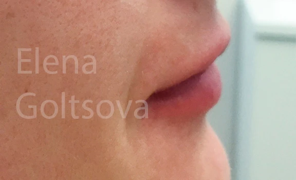 коррекции сложных тонких губ препаратом Belotero Intense, фото после процедуры