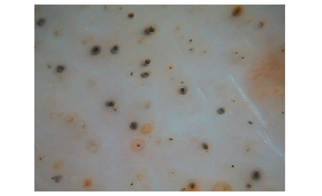 Диагностика гнездой алопеции 