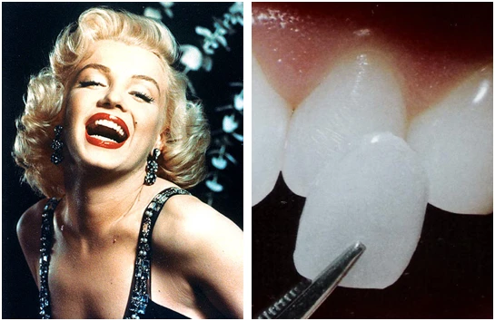 Голливудская улыбка