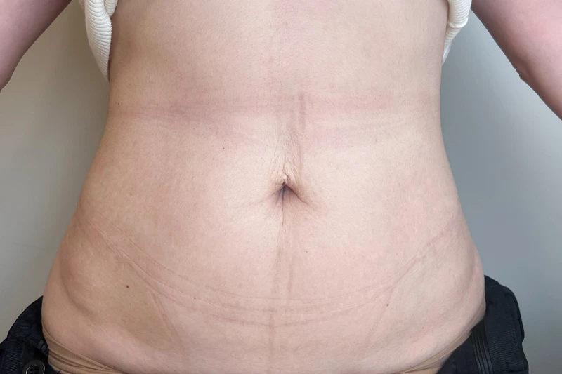 Комбинированный протокол Ulfit + Volnewmer, фото после