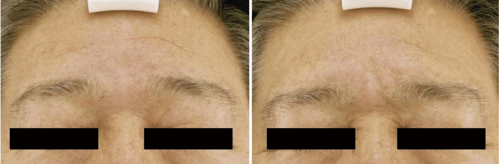 До и после Scarlet RF