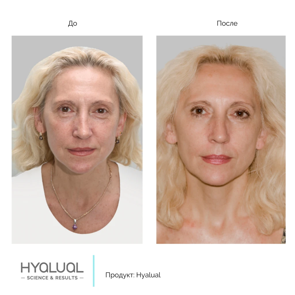 Hyalual 2,2 %, фото до и после