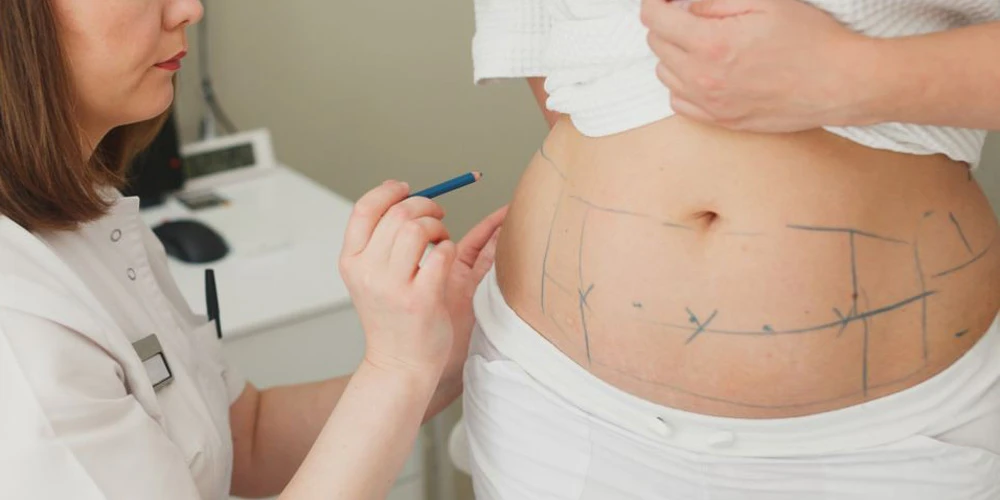 виды липосакции