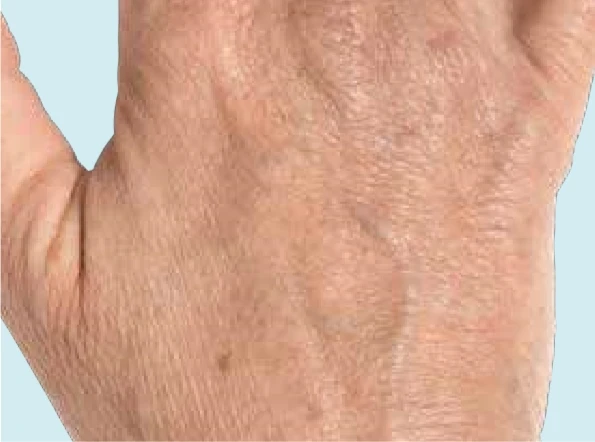 Коррекция зоны рук филлером Radiesse