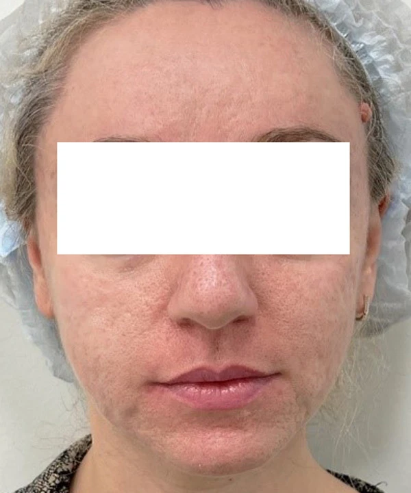 Harmony XL Pro, фото после