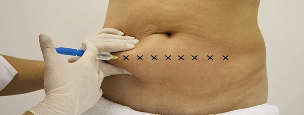 Протокол мезокоррекции локальных жировых отложений