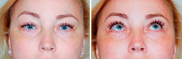 через 3 месяца после операции