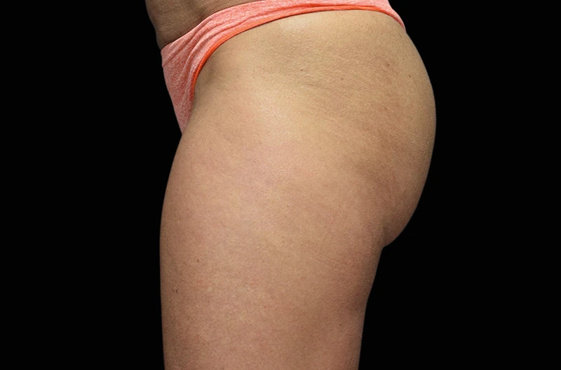 Фото после 4 процедур на аппарате EMSCULPT