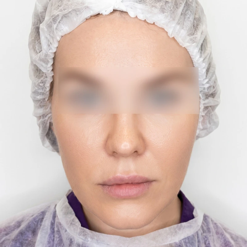 HyalCode Comfort