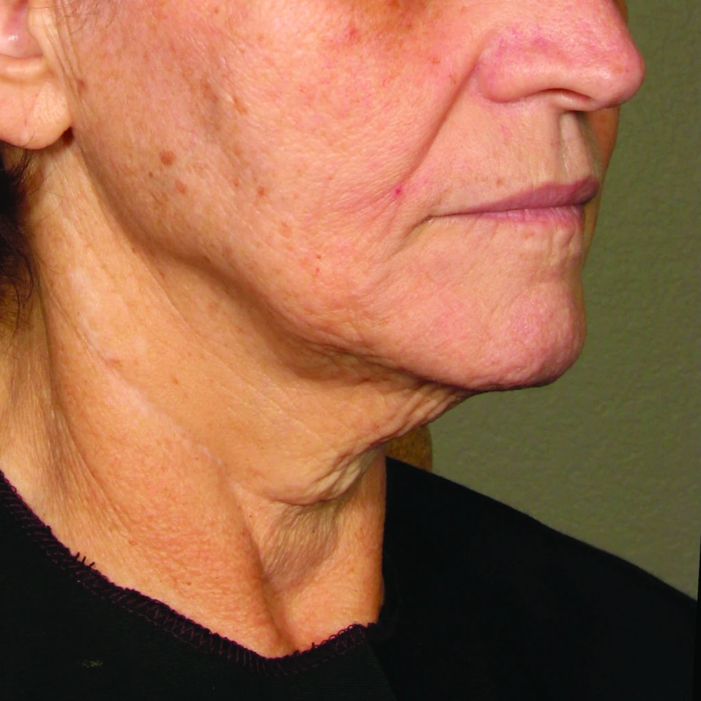 Ultherapy После