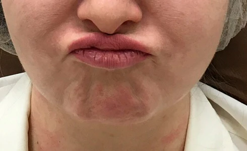 Ксеомин, Подбородочная мышца