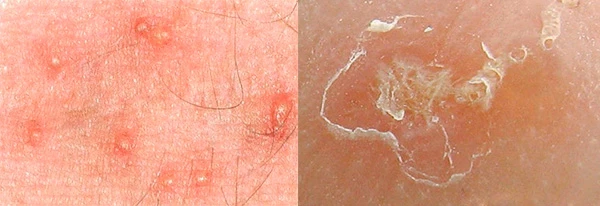 Дерматоскопия