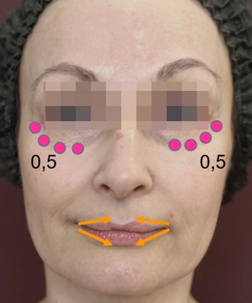 Разметка для инъецирования Belotero