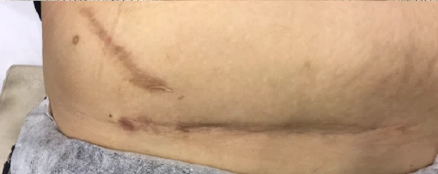 Радиочастотный лифтинг Scarlet RF, фото до