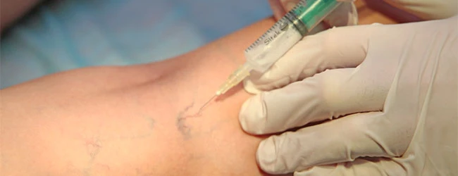 Коррекция сосудистых образований