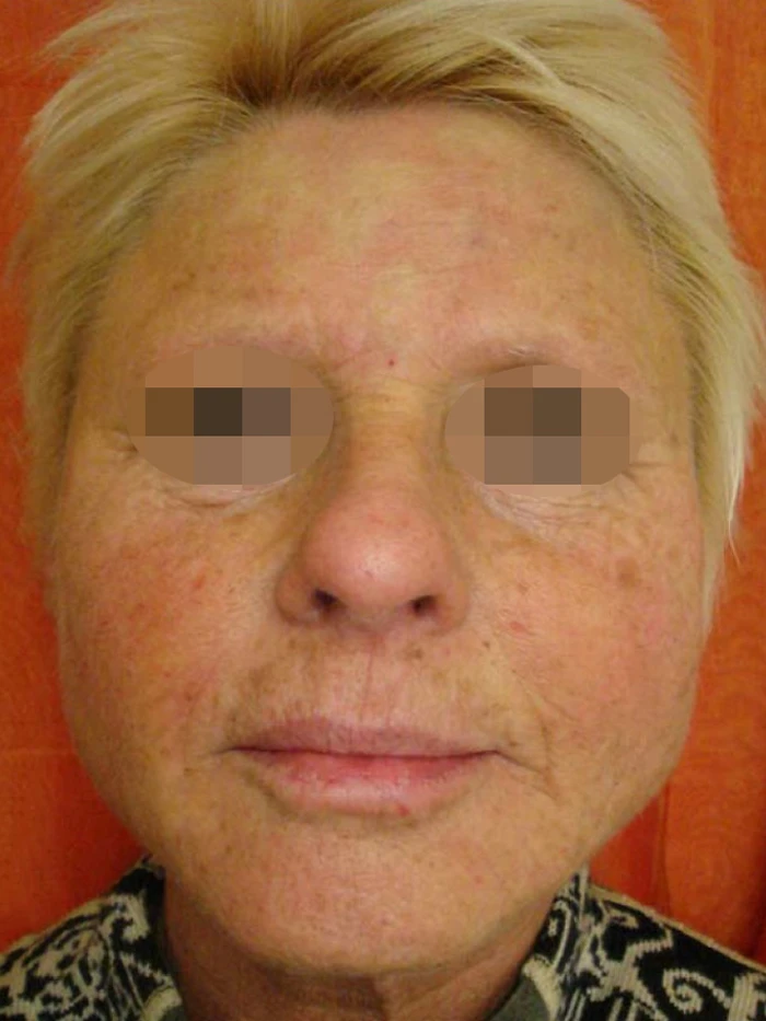 Cellenis® PRP фото после